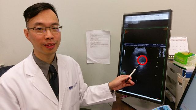 攝護腺肥大尿滯留送急診 新式雷射剜除手術復發率低