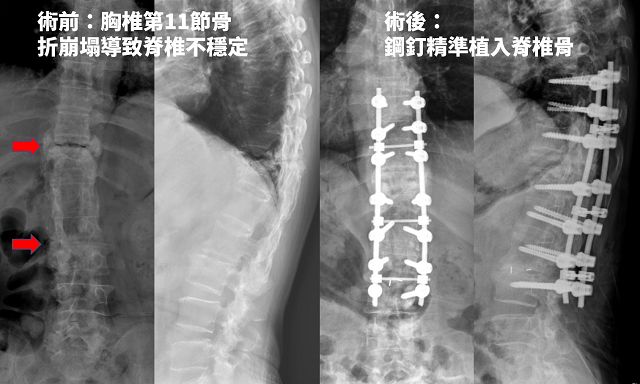 68歲癱婦翻身椎心痛　雷納生機械手臂術後重獲新生