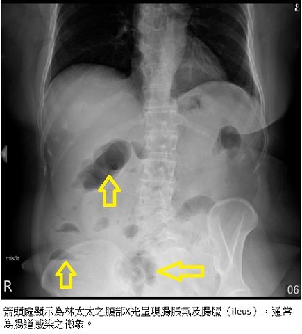 中秋烤肉這樣做　避免急性腸胃炎找上門