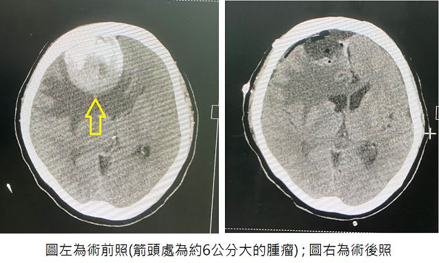 常忘東忘西、頭暈頭痛? 當心是腦腫瘤作祟